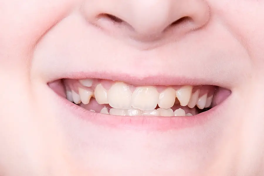 3 Problems Created By Crowded And Crooked Teeth