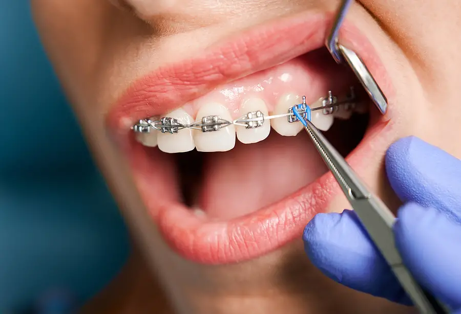 How To Prepare For And Improve Your Braces Journey