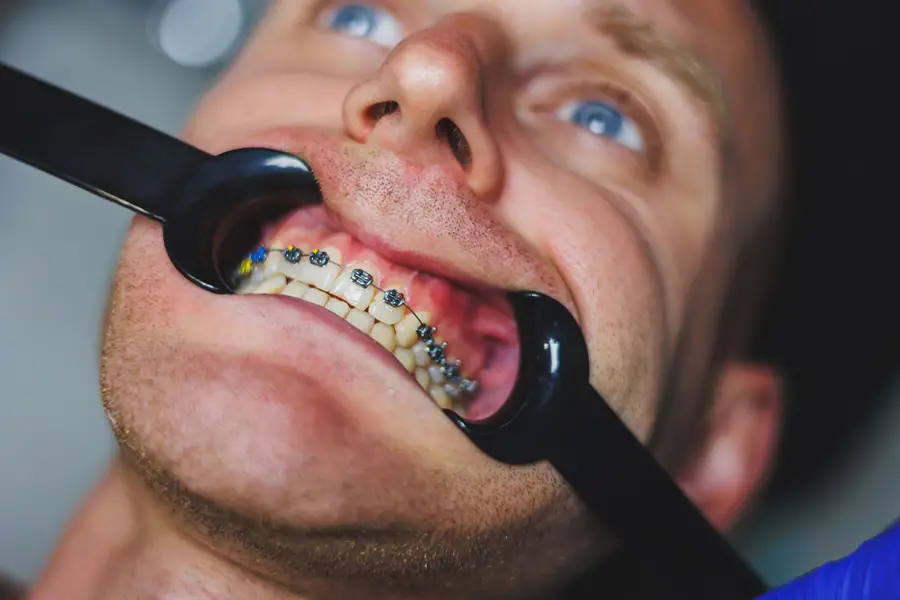 How to Help Your Child Take Care of Their Teeth While They Have Braces