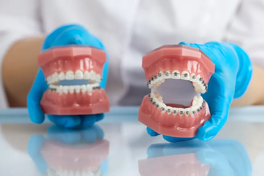 Invisalign Vs Braces: How Long Will Treatment Last?