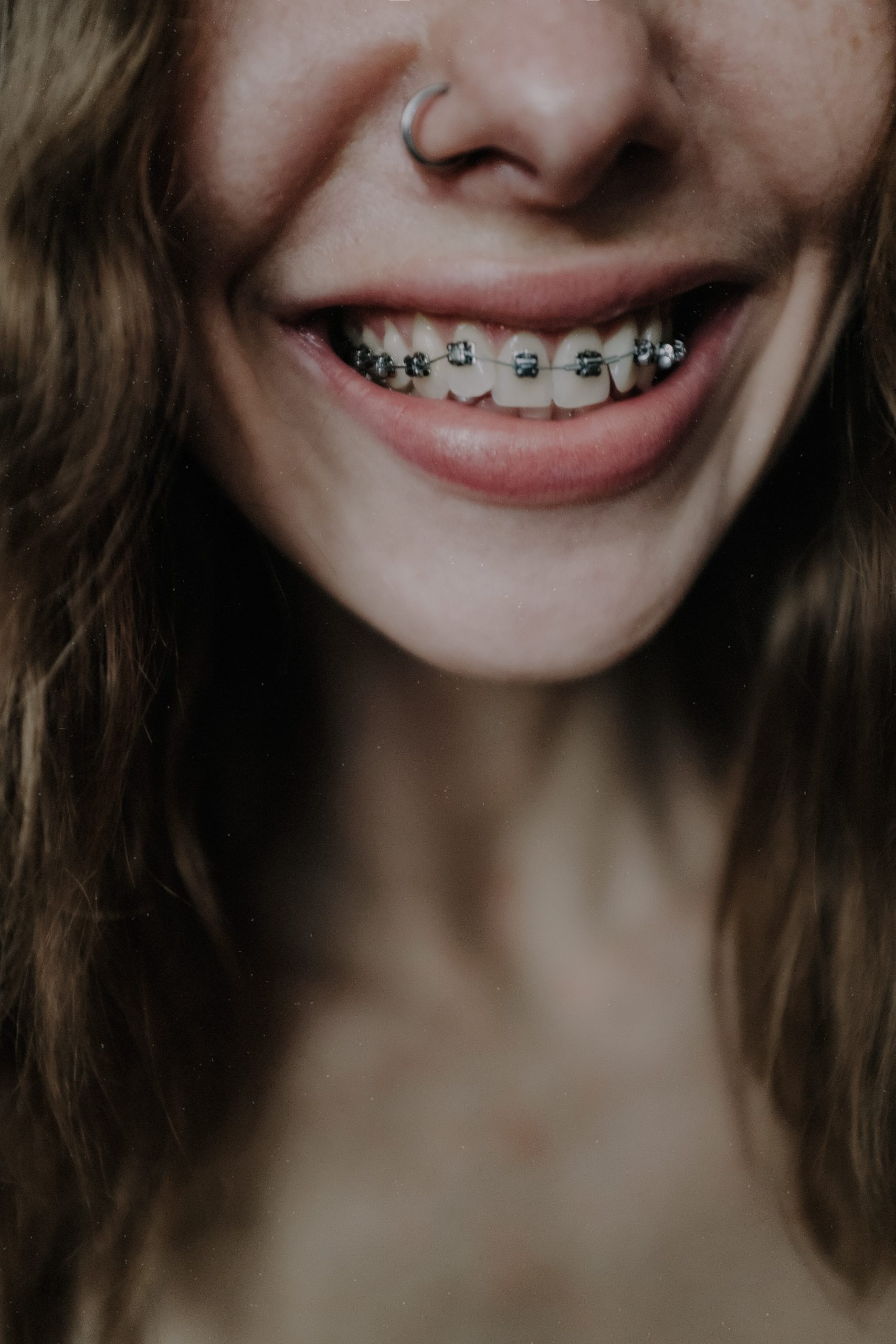 The Journey to a Straighter Smile with Metal Braces