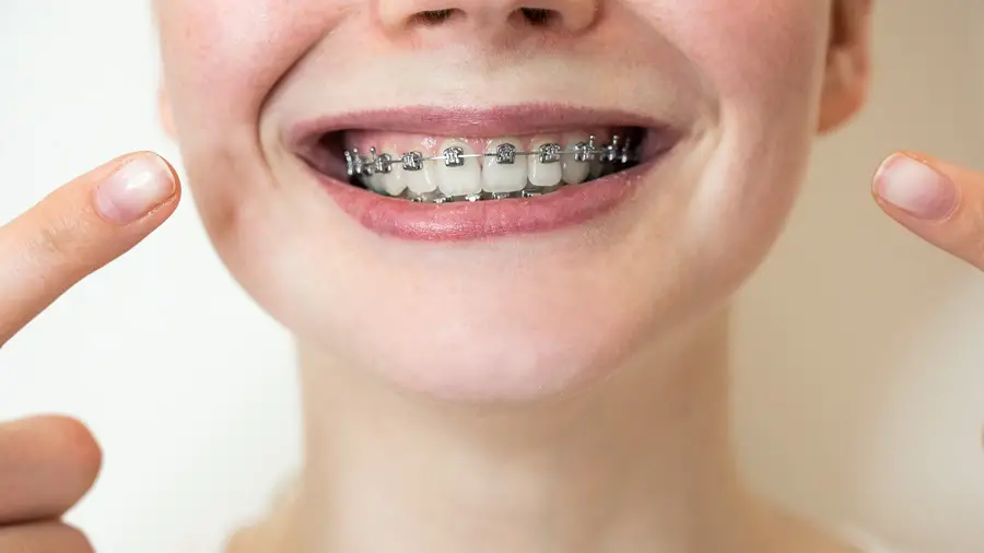 What Adults Can Expect When Getting Braces