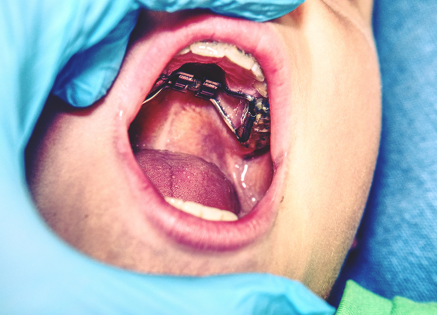 Palatal Expanders: A Key to Improved Oral Health and Development